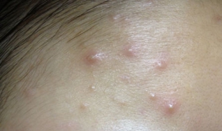 少女额头长青春痘怎么办（青春期少女额头长痘痘怎么办）