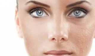 额头毛孔大怎么办 额头毛孔大怎样去除