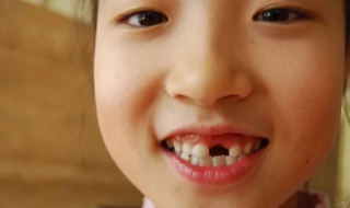 门牙掉了怎么办（中年人门牙掉了怎么办）