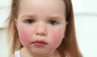 脸红怎么办 脸红怎么办消红