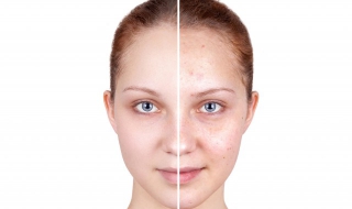 脸上青春痘怎么办（十四岁脸上青春痘怎么办）