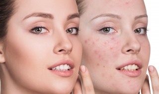 脸上长痘痘怎么办（脸上长痘痘怎么办男生）
