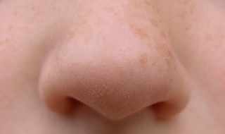 脸上长小粉刺怎么办（脸上长粉刺怎么办?去粉刺小窍门）