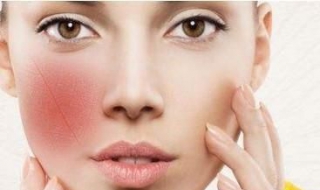 脸颊红血丝怎么办 脸颊红血丝怎么办才能消除