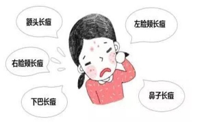 脸上长痘怎么办（脸上长痘怎么办 怎样去除）