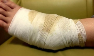 脚踝韧带拉伤怎么办 脚踝韧带拉伤怎么办恢复