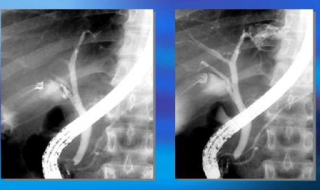 肝内胆管结石怎么办 胆肠吻合术后肝内胆管结石怎么办