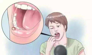 经常口腔溃疡怎么办（孩子经常口腔溃疡怎么办）
