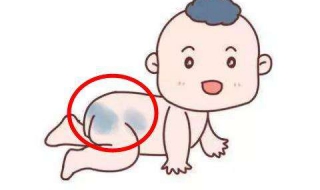 新生儿有胎记怎么办（宝宝有胎记该怎么办）