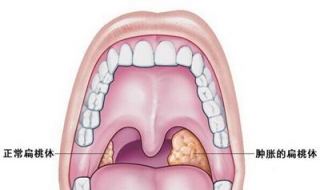 扁桃体发炎引起发烧怎么办 老是扁桃体发炎引起发烧怎么办