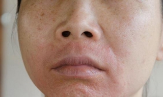 脸过敏发红怎么办 六个月宝宝脸过敏发红怎么办