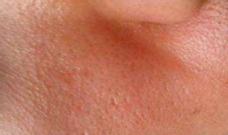 脸颊毛孔大怎么办（脸颊毛孔大怎么办改善）