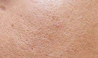 脸颊毛孔粗怎么办 脸颊毛孔粗大怎么办