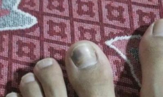 脚趾甲灰指甲怎么办 脚趾甲灰指甲怎么办一般怎么治疗