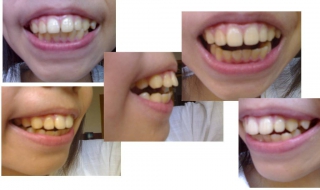 暴牙怎么办（暴牙怎么办查看这个）