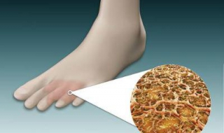 有脚气怎么办（有脚气怎么办才能根除）