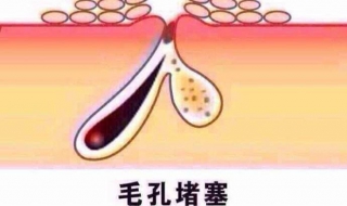 毛孔堵塞怎么办 腿上毛孔堵塞怎么办