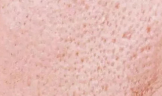 毛孔特别粗大怎么办（毛孔特别粗大怎么办?）