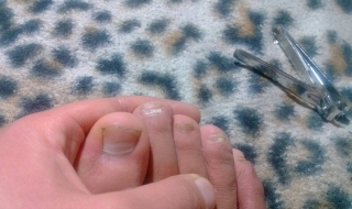 脚趾甲发白怎么办 脚趾甲发白怎么办图片