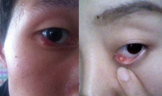 眼睛长针眼怎么办（眼睛长针眼怎么办图片）