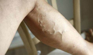 腿上有青筋怎么办 腿上有青筋怎么办图片