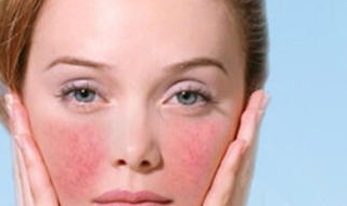 脸部红血丝怎么办 脸部红血丝严重怎么办