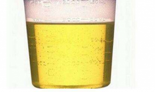 尿血怎么办 尿血怎么办最快最有效