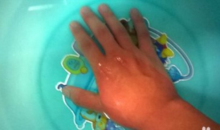 开水烫了怎么办（舌头被开水烫了怎么办）