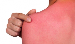 晒伤了怎么办（盆栽被晒伤了怎么办）