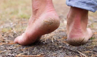 脚裂口怎么办（冬天脚裂口怎么办）