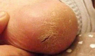 脚裂怎么办 冬季脚裂怎么办