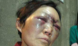 脸被打肿了怎么办（脸被打肿了怎么办冷敷还是热敷好）