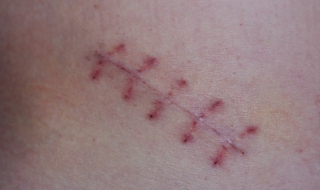 脸上有疤痕怎么办 小孩子脸上有疤痕怎么办