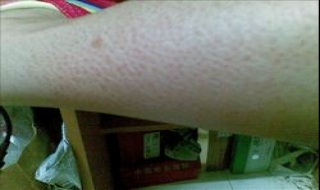 腿上皮肤粗糙怎么办（腿上皮肤很粗糙怎么办）