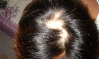 洗头掉头发很厉害怎么办 洗头掉头发很厉害怎么办呢