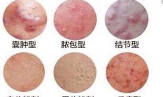 脸颊长痤疮怎么办（脸颊长了痤疮怎么办）