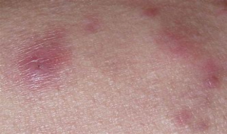 后背上起疙瘩怎么办 后背起疙瘩咋办