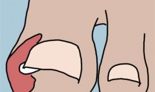 脚趾甲沟炎怎么办 大母脚趾甲沟炎怎么办