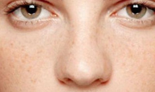 脸上长色斑怎么办 脸上长色斑怎么办图片