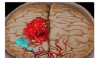 腔隙性脑梗塞怎么办 左侧基底节区腔隙性脑梗塞怎么办