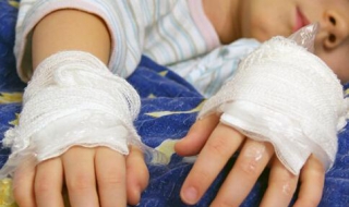 孩子烫伤怎么办（孩子烫伤怎么办,泡破了怎么办）