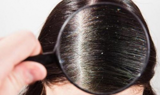 头皮屑多又痒怎么办（头皮屑多痒是什么原因怎么治疗）