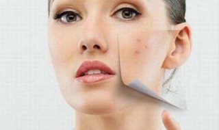 脸上长青春痘怎么办 脸上长青春痘怎么办13岁