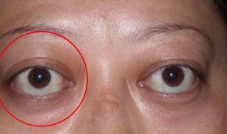 眼球突出怎么办 玩手机眼球突出怎么办