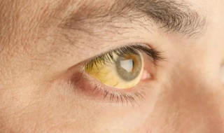 眼球发黄怎么办（乙肝眼球发黄怎么办）