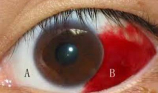 眼球出血怎么办（戴美瞳眼球出血怎么办）