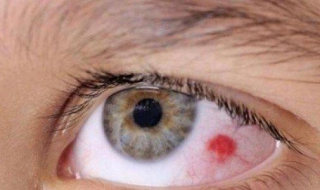 眼球充血怎么办 用眼过度眼球充血怎么办