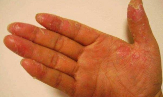 手脱皮怎么办 手脱皮怎么办教你三招轻松搞定