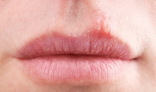 嘴上长泡怎么办（嘴上长泡怎么办能快速去掉呢）