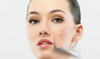 满脸痘印怎么办 满脸痘印怎么办才能消除